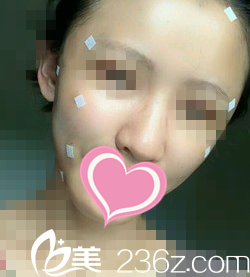 脂肪填充全臉天 脂肪填充全臉天