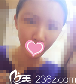 術(shù)后第3天效果 術(shù)后第3天效果