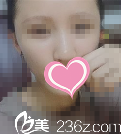 術(shù)后一周恢復(fù)情況 術(shù)后一周恢復(fù)情況