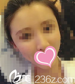 自體脂肪填充面部術(shù)后20天恢復(fù)效果 自體脂肪填充面部術(shù)后20天恢復(fù)效果