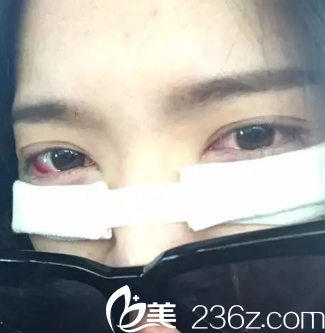 紅腫還沒消 紅腫還沒消