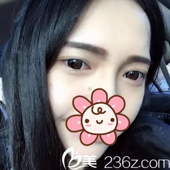 <!--<i data=20240703-sp></i>-->院長給我去完眼袋半個月了 <!--<i data=20240703-sp></i>-->院長給我去完眼袋半個月了