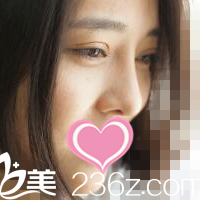 術(shù)后2個(gè)月 術(shù)后2個(gè)月