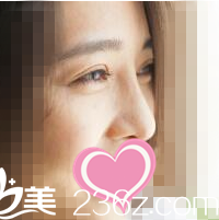 在韓國時蘊整形醫(yī)院做雙眼皮+開眼角+鼻綜合后 灰姑娘華麗蛻變女神