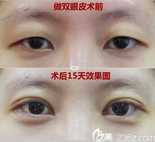 切開雙眼皮15天效果圖 切開雙眼皮15天效果圖