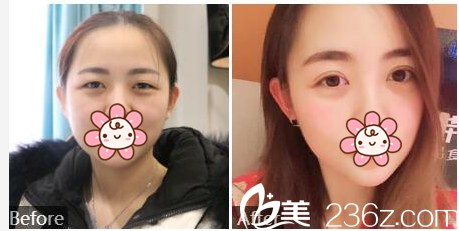 東莞韓美整形醫(yī)院黃玉潔雙眼皮案例 東莞韓美整形醫(yī)院黃玉潔雙眼皮案例