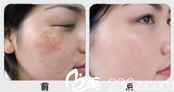 東莞韓美整形醫(yī)院劉來君激光祛斑案例 東莞韓美整形醫(yī)院劉來君激光祛斑案例