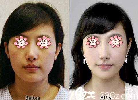 玻尿酸填充下巴案例