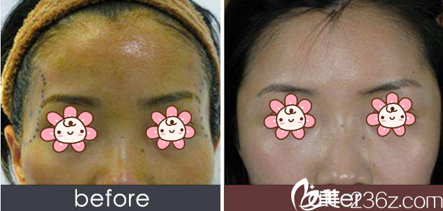 玻尿酸豐太陽穴案例