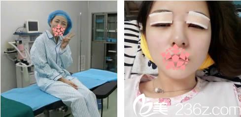 剛做完全切雙眼皮的照片