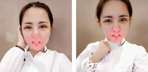 做完雙眼皮7天拆線后的圖片