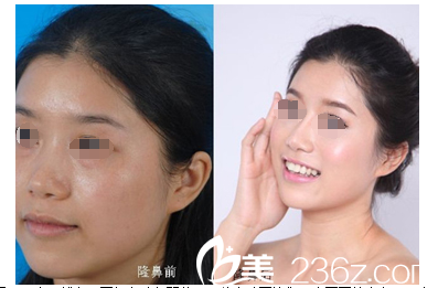 都說整容上癮，去常熟圣莎拉做了韓式綜合隆鼻后又做了光纖溶脂瘦臉