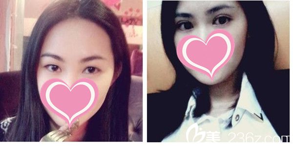 史希杰醫(yī)師雙眼皮手術(shù)真人案例