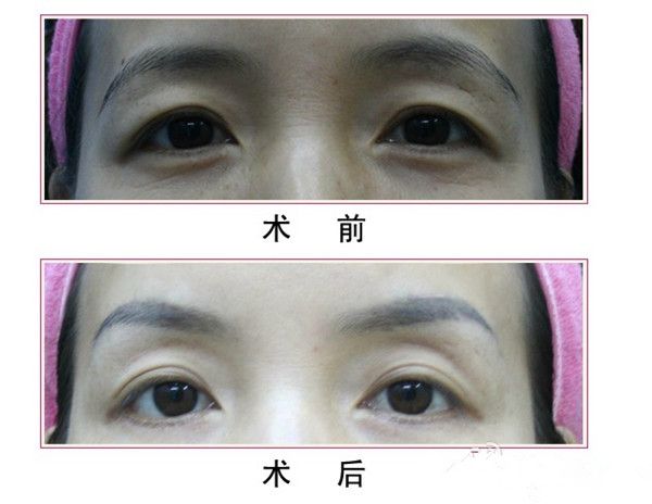 易軍學雙眼皮手術真人案例 易軍學雙眼皮手術真人案例