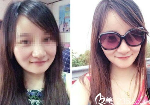 易軍學瘦臉手術真人案例 易軍學瘦臉手術真人案例