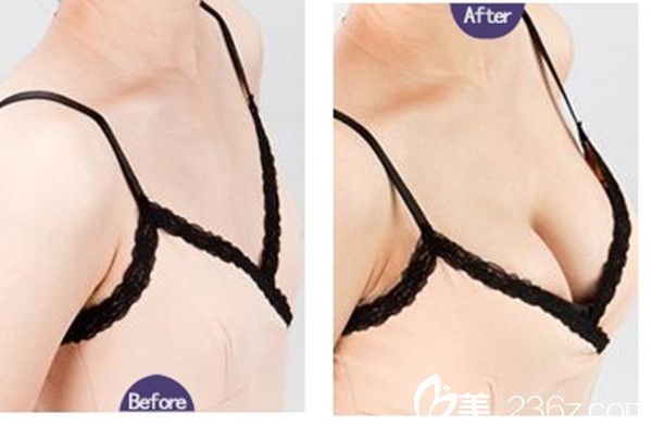 鄒琪隆胸手術(shù)真人案例 鄒琪隆胸手術(shù)真人案例