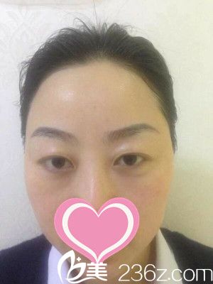 <!--<i data=20240703-sp></i>-->整形醫(yī)院易軍學(xué)雙眼皮手術(shù)真人案例 <!--<i data=20240703-sp></i>-->整形醫(yī)院易軍學(xué)雙眼皮手術(shù)真人案例