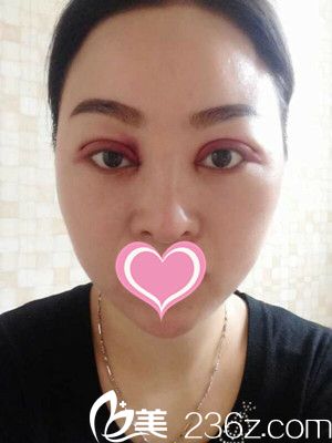 易軍學(xué)雙眼皮手術(shù)真人案例 易軍學(xué)雙眼皮手術(shù)真人案例