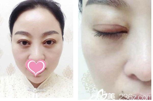 術(shù)后一個(gè)月 術(shù)后一個(gè)月