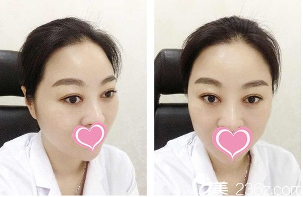 整形易軍學(xué)做雙眼皮怎么樣？看寶媽術(shù)后的恢復(fù)效果