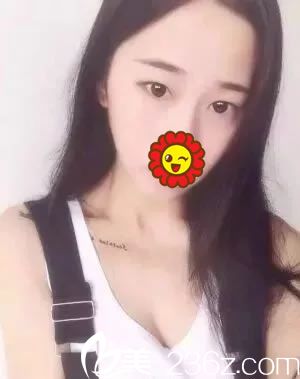 做雙眼皮手術(shù)前的內(nèi)雙照片 做雙眼皮手術(shù)前的內(nèi)雙照片