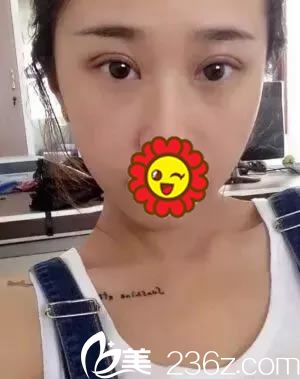 做雙眼皮手術(shù)第7天拆線的<span style= 做雙眼皮手術(shù)第7天拆線的<span style=