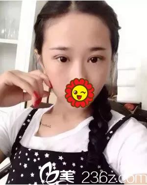 找徐建國(guó)割雙眼皮手術(shù)10天<span style= 找徐建國(guó)割雙眼皮手術(shù)10天<span style=