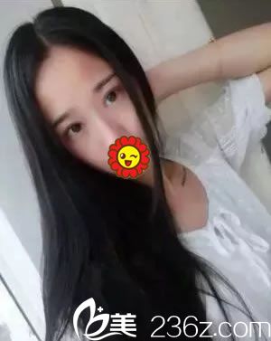 寧波建國(guó)整形做雙眼皮15天恢復(fù)照 寧波建國(guó)整形做雙眼皮15天恢復(fù)照