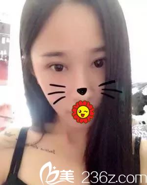 終于把心心念念的雙眼皮找寧波徐建國整形給做了 20天恢復效果比以前好看多了