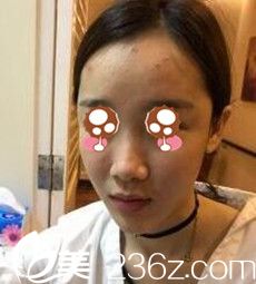 隆鼻術(shù)前 隆鼻術(shù)前