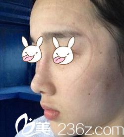 說我鼻子丑鞋拔子臉 索性在南陽維多利亞做了隆鼻