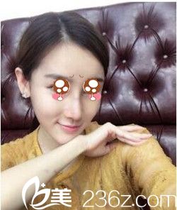 隆鼻術(shù)后7天 隆鼻術(shù)后7天