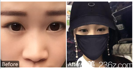 東莞莞城美立方整形醫(yī)院張克做的雙眼皮案例