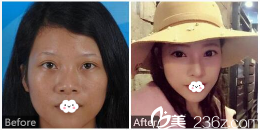 東莞美立方宋兆丹做的隆鼻案例圖片