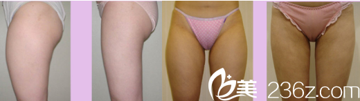 韓國Lilac BLC整形外科醫(yī)院案例