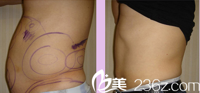 韓國(guó)Lilac BLC整形外科醫(yī)院案例