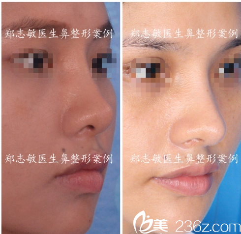 東莞美立方鄭志敏做的中隔軟骨鼻綜合隆鼻案例 東莞美立方鄭志敏做的中隔軟骨鼻綜合隆鼻案例