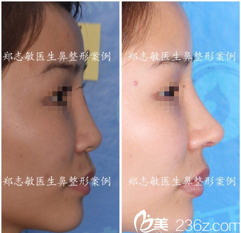東莞美立方鄭志敏醫(yī)生肋軟骨鼻綜合隆鼻案例圖 東莞美立方鄭志敏醫(yī)生肋軟骨鼻綜合隆鼻案例圖