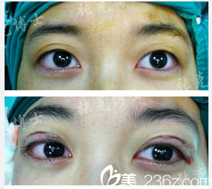 東莞美立方張克醫(yī)生雙眼皮修復(fù)案例 東莞美立方張克醫(yī)生雙眼皮修復(fù)案例
