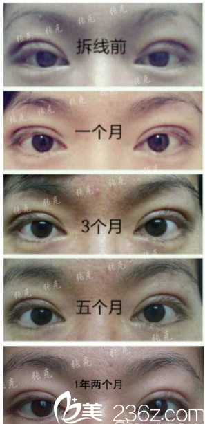 東莞美立方張克醫(yī)生雙眼皮案例恢復(fù)過程圖 東莞美立方張克醫(yī)生雙眼皮案例恢復(fù)過程圖