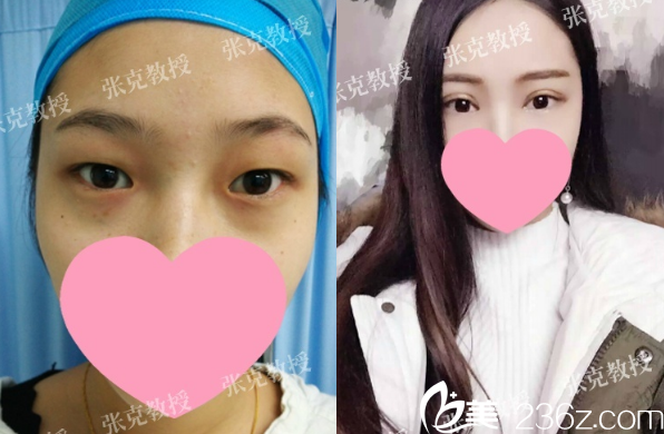 東莞美立方張克醫(yī)生做的生態(tài)靈動(dòng)雙眼皮案例 東莞美立方張克醫(yī)生做的生態(tài)靈動(dòng)雙眼皮案例