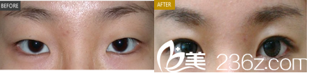 北京藝美鞏敏開眼角案例 北京藝美鞏敏開眼角案例