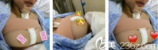 魯禮新醫(yī)生給我做的假體隆胸手術天