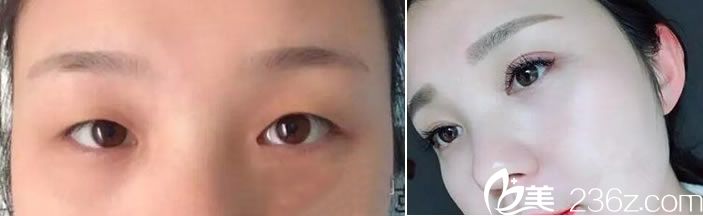 <!--<i data=20240703-sp></i>-->魏敬想醫(yī)生雙眼皮真人案例 <!--<i data=20240703-sp></i>-->魏敬想醫(yī)生雙眼皮真人案例