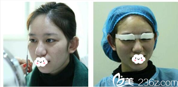 術(shù)前單眼皮照片 術(shù)前單眼皮照片