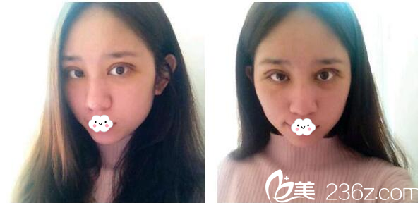在東莞美立方做完雙眼皮8天效果 在東莞美立方做完雙眼皮8天效果