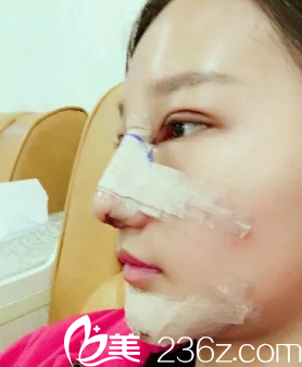 達州雙均劉隆才給我做的假體隆鼻手術(shù) 達州雙均劉隆才給我做的假體隆鼻手術(shù)