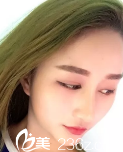 6月1號(hào)在達(dá)州雙均整形醫(yī)院做的假體隆鼻手術(shù)日記分享