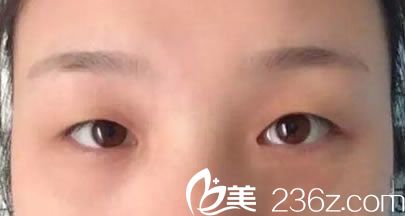 在心悅做雙眼皮手術(shù)前單眼皮照片 在心悅做雙眼皮手術(shù)前單眼皮照片