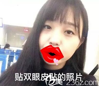做雙眼皮手術(shù)前貼眼皮貼的照片 做雙眼皮手術(shù)前貼眼皮貼的照片